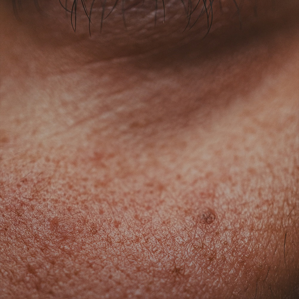 Dry skin + Fine Lines -